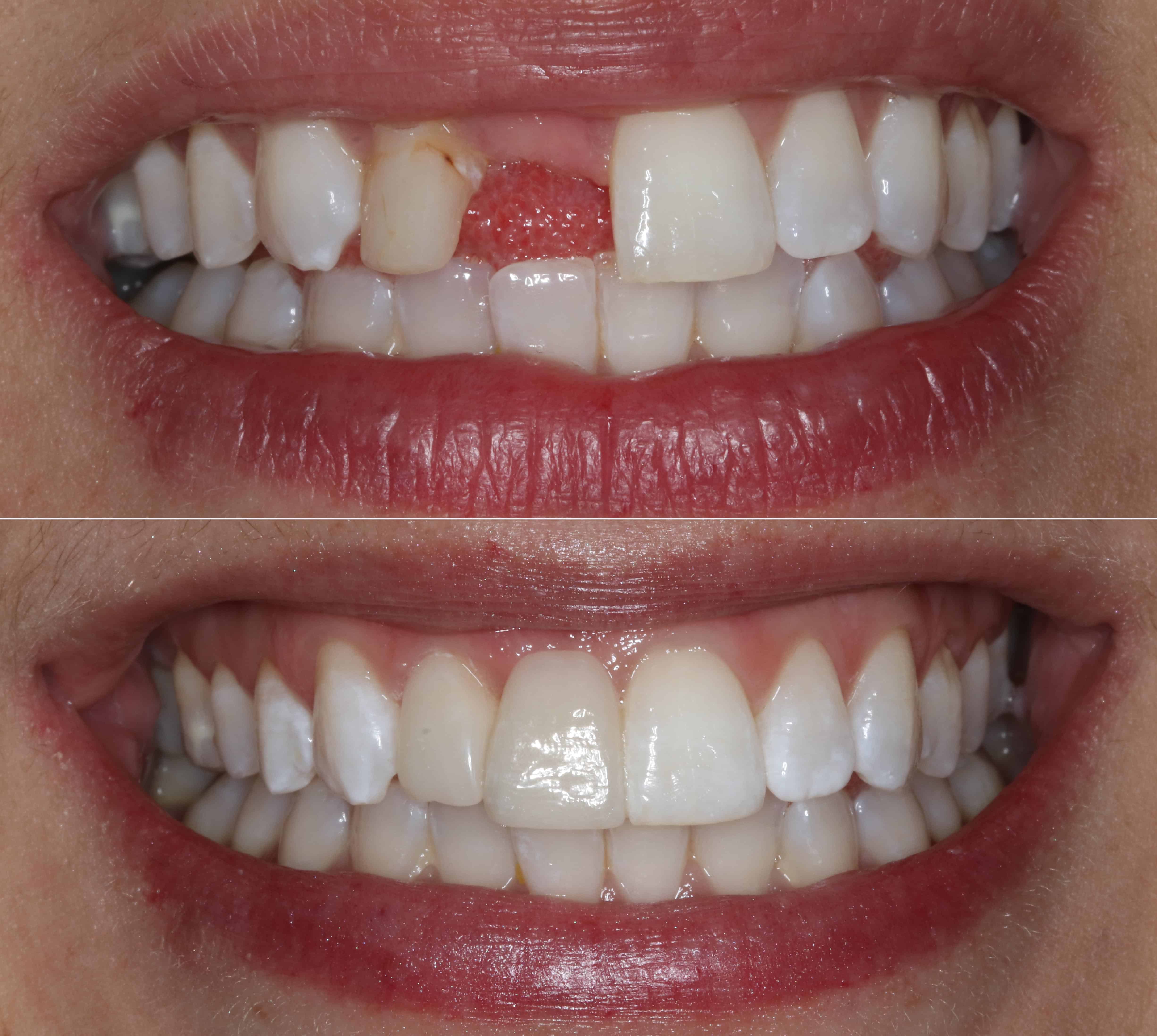 Dental Bridge Front Teeth