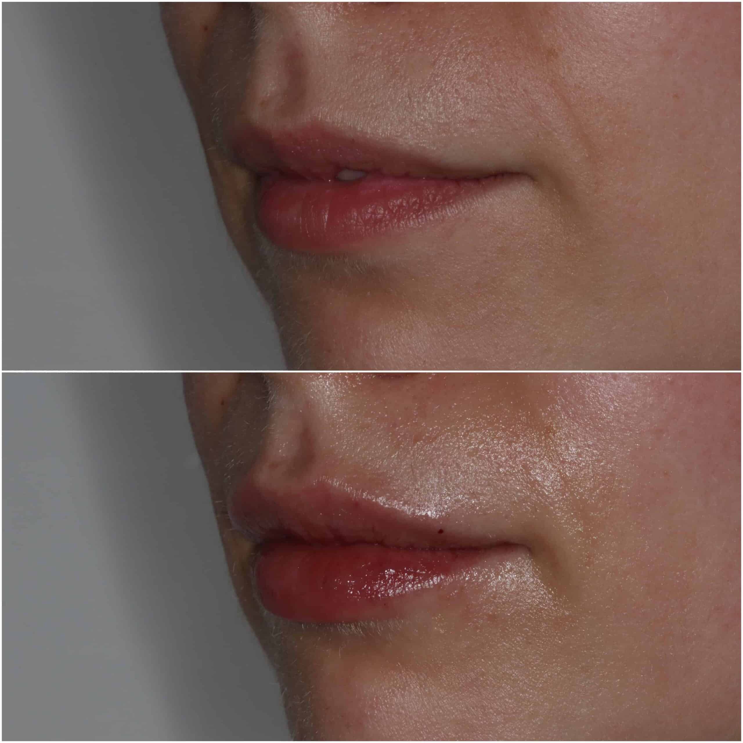 Dermal Fillers - The Image Shows A Before-and-after Comparison Of A Dermal Filler Treatment At Beverley Dental In Raynes Park. The Top Half Of The Image Depicts The Patient's Lips Before The Treatment, With A Natural But Slightly Thinner Appearance. The Bottom Half Reveals The Results After The Dermal Filler Procedure, Showcasing Fuller And More Defined Lips. This Visual Highlights The Effectiveness Of The Dermal Fillers Administered By Beverley Dental, Emphasizing Their Proficiency In Cosmetic Enhancements And Dedication To Improving Patients' Facial Aesthetics Through Advanced Techniques. The Close-up View Underscores The Clinic's Attention To Detail And Commitment To Delivering Natural-looking Results.