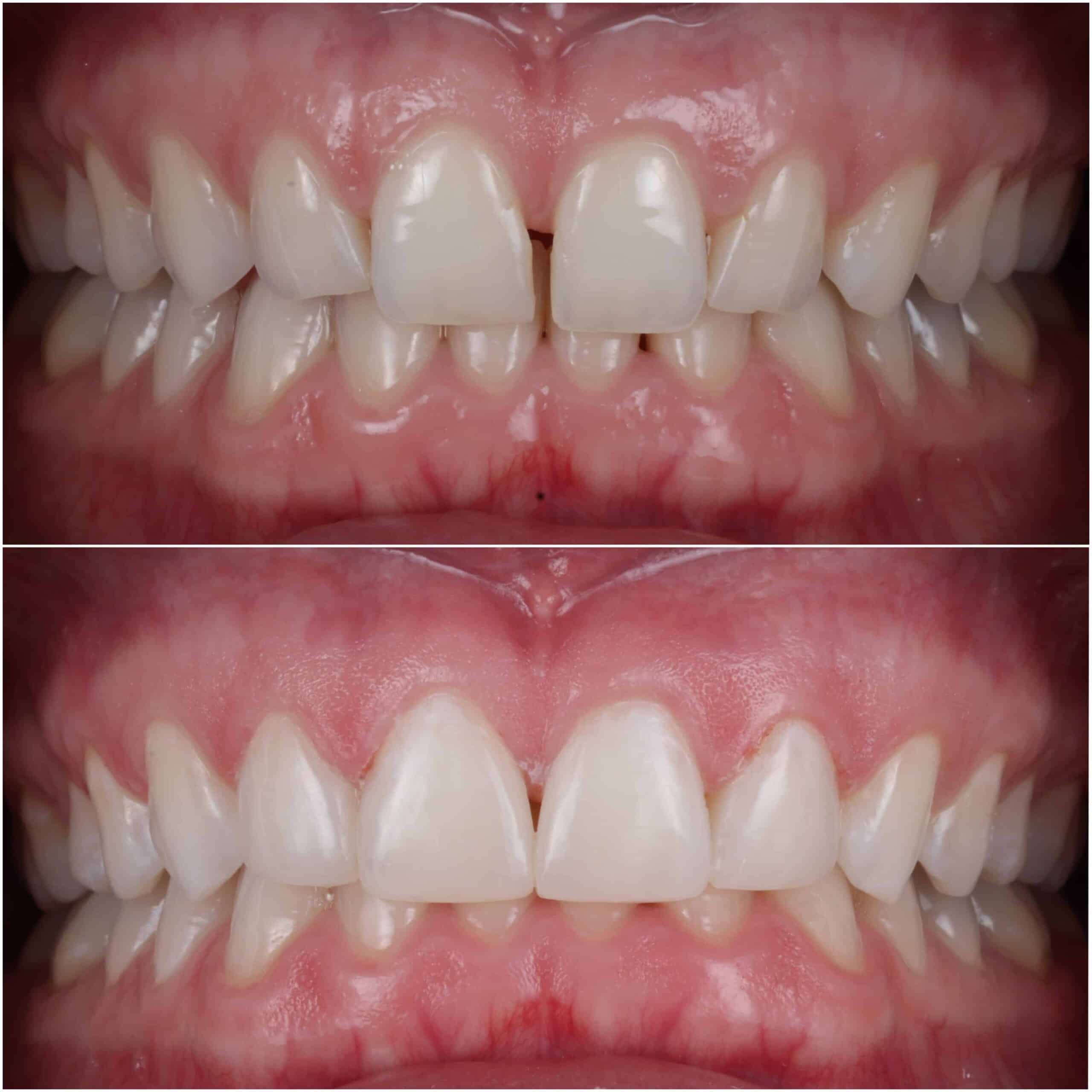 Composite Bonding Raynes Park - A Patient Showcases Their Dental Transformation Through Composite Bonding At Beverley Dental In Raynes Park. The Image Presents A Before-and-after Comparison Of The Patient's Teeth. In The 