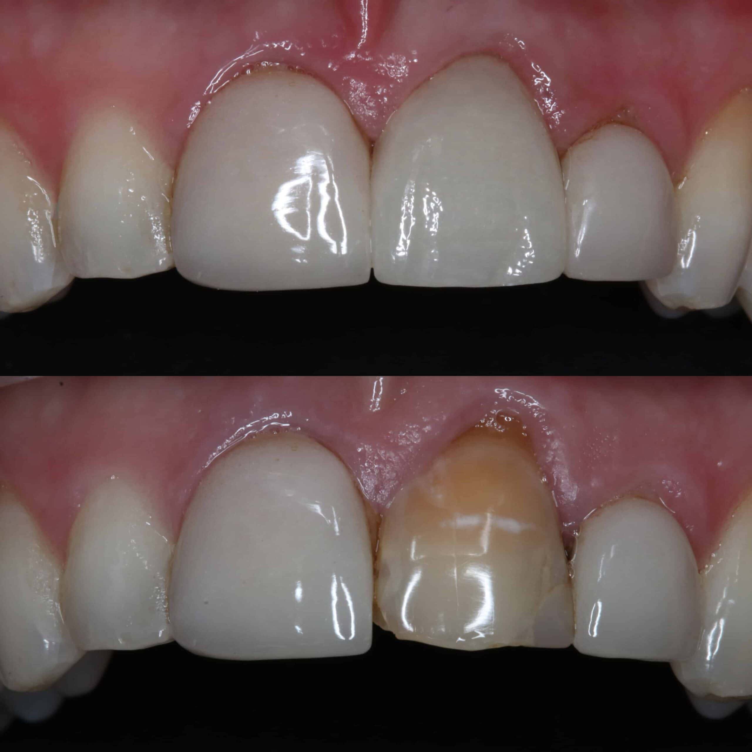 Dental Crowns Raynes Park - The Image Illustrates The Process Of Dental Crowns At Beverley Dental In Raynes Park. The Upper Section Showcases The Final Result With Perfectly Fitted And Natural-looking Crowns, Restoring The Aesthetics And Function Of The Patient's Front Teeth. The Lower Section Reveals The Pre-treatment Condition, With Noticeable Wear And Discoloration Of The Natural Teeth Before The Crowns Were Placed. This Transformation Highlights The Expertise Of Beverley Dental In Providing High-quality Dental Crowns, Enhancing Both The Appearance And Oral Health Of Their Patients. The Meticulous Craftsmanship And Attention To Detail Are Evident In The Seamless Integration Of The Crowns With The Patient's Natural Teeth.