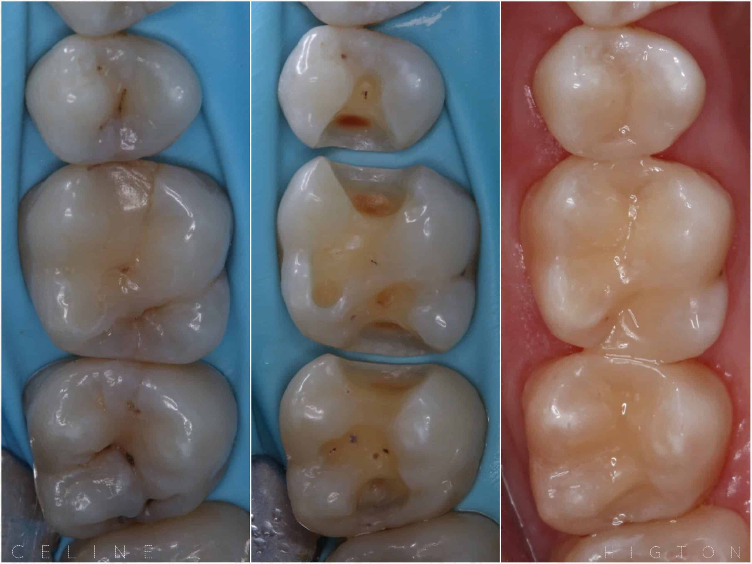 Dental Restorations Raynes Park - The Image Showcases A Series Of Dental Restorations Performed At Beverley Dental In Raynes Park. The Left Section Displays Two Molars With Visible Cavities And Decay. The Middle Section Shows The Same Teeth After Decay Removal, Prepared For Restoration With Protective Blue Rubber Dam Isolation. The Right Section Highlights The Final Restorations, Exhibiting Smooth, Natural-looking Surfaces Matching The Patient's Other Teeth. This Process At Beverley Dental Exemplifies Their Expertise In Restoring Dental Health And Aesthetics Using Advanced Techniques And Materials.