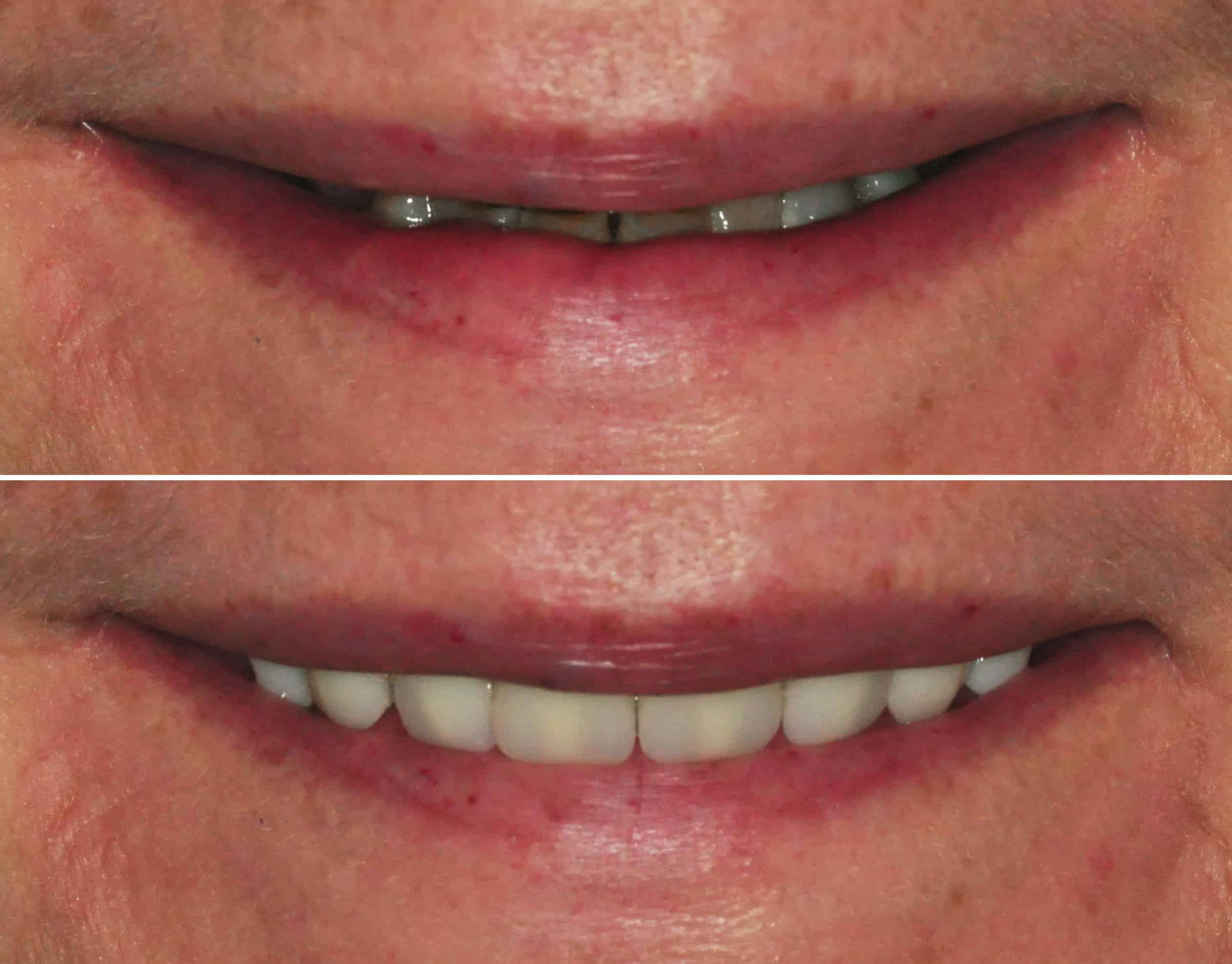 Dentures Raynes Park - The Image Presents A Before-and-after Comparison Of A Patient Fitted With Dentures At Beverley Dental In Raynes Park. The Upper Section Shows The Patient With Missing Upper Front Teeth, Displaying A Need For Dental Restoration. The Lower Section Reveals The Completed Treatment With The Placement Of Full Dentures, Providing A Natural And Complete Smile. This Transformation Highlights Beverley Dental's Proficiency In Creating Custom Dentures, Restoring Both The Aesthetic Appearance And Functional Capabilities Of The Patient's Mouth. The Clinic Is Dedicated To Offering High-quality Prosthetic Solutions, Ensuring That Patients Regain Confidence And Improved Oral Health.