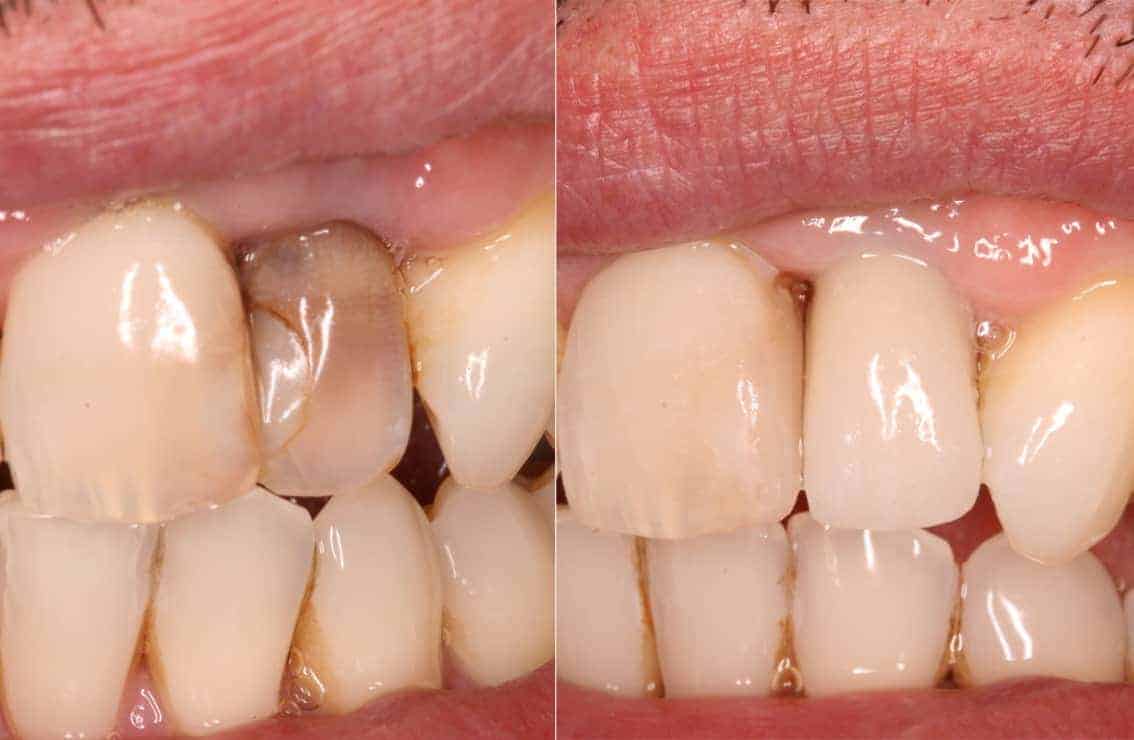 Porcelain Veneers Raynes Park - A Patient's Teeth Transformation Is Showcased Through The Application Of Porcelain Veneers At Beverley Dental In Raynes Park. The Image Presents A Side-by-side Comparison Of The Teeth Before And After The Veneer Treatment. On The Left, The Patient's Teeth Show Significant Discoloration And Staining. On The Right, The Teeth Appear Much Brighter And Uniformly Colored, Demonstrating The Dramatic Improvement Achieved With Porcelain Veneers. This Transformation Highlights The Effectiveness Of Veneers In Restoring Dental Aesthetics And Boosting Confidence. Beverley Dental In Raynes Park Demonstrates Their Expertise In Cosmetic Dentistry, Ensuring High-quality Care And Stunning Results For Their Patients.