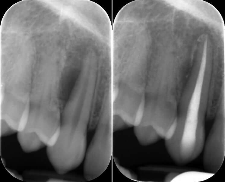 Root Canal Raynes Park - The Image Displays A Dental X-ray Series Taken At Beverley Dental In Raynes Park, Illustrating A Root Canal Procedure. The Left X-ray Shows The Initial State Of The Tooth With Significant Infection And Decay Reaching The Root Canal. The Right X-ray Reveals The Same Tooth After The Root Canal Treatment, Showcasing The Cleaned And Filled Canal, Successfully Eliminating The Infection. This Sequence Highlights Beverley Dental's Proficiency In Performing Root Canals, Aiming To Preserve Natural Teeth And Restore Oral Health. The Use Of Advanced Diagnostic Imaging Underscores The Clinic's Commitment To Precise And Effective Dental Care.