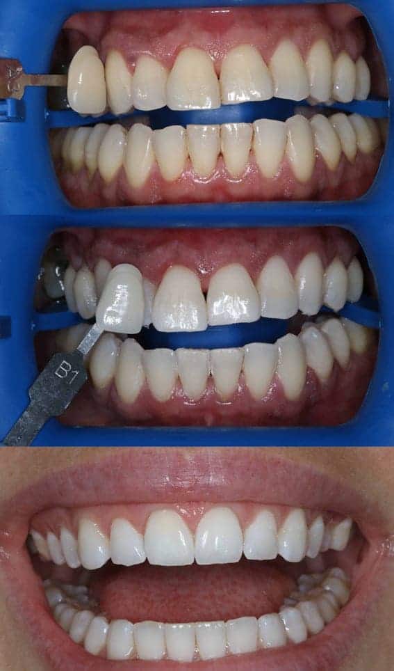 Teeth Whitening Raynes Park - A Patient Undergoes A Teeth Whitening Procedure At Beverley Dental In Raynes Park. The Image Showcases A Step-by-step Transformation Of The Patient's Teeth. The Top Section Depicts The Initial State Of The Teeth, With A Color-matching Tool Being Used To Compare Shades. The Middle Section Shows The Whitening Process In Progress, With The Teeth Appearing Visibly Brighter As The Shade Comparison Tool Indicates The Change. The Bottom Section Displays The Final Result, With The Patient's Teeth Significantly Whiter And More Uniform In Color. This Sequence Highlights The Effectiveness Of Teeth Whitening Treatments At Beverley Dental In Raynes Park, Emphasizing The Clinic's Commitment To Enhancing Dental Aesthetics And Patient Satisfaction.